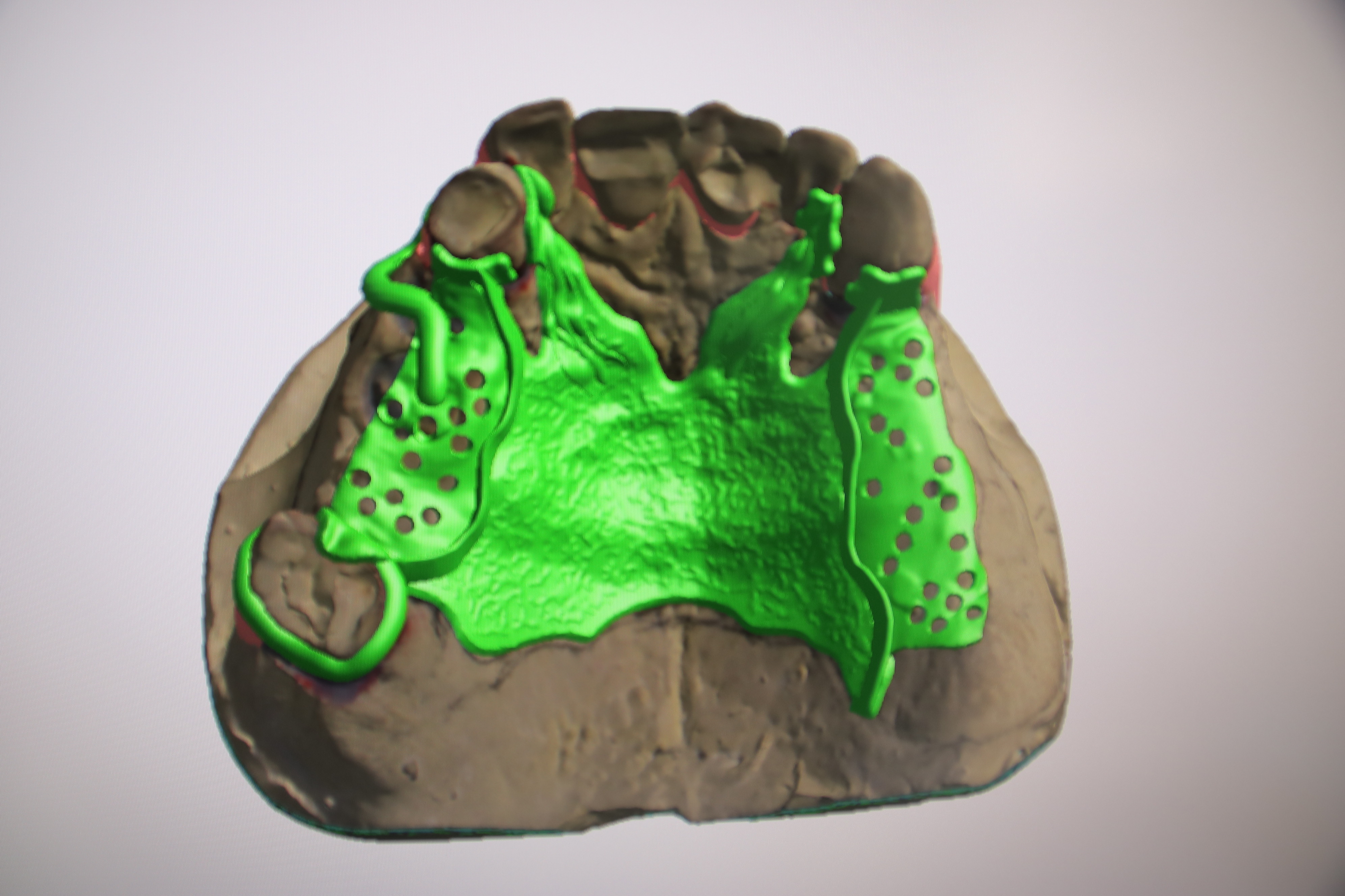 デジタル技工で金属床も - 歯科技工所 株式会社ファインデンタル