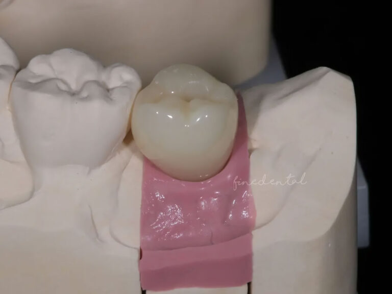 Implant_zirconia02