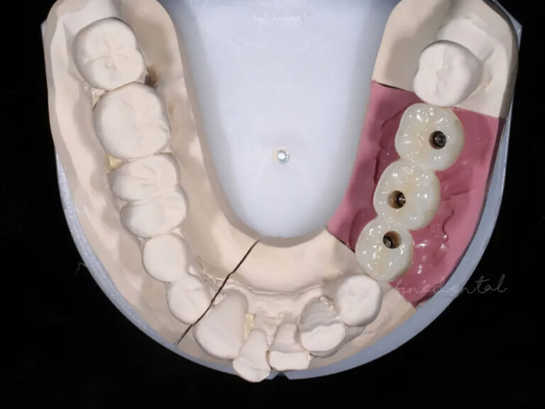 Implant_zirconia03