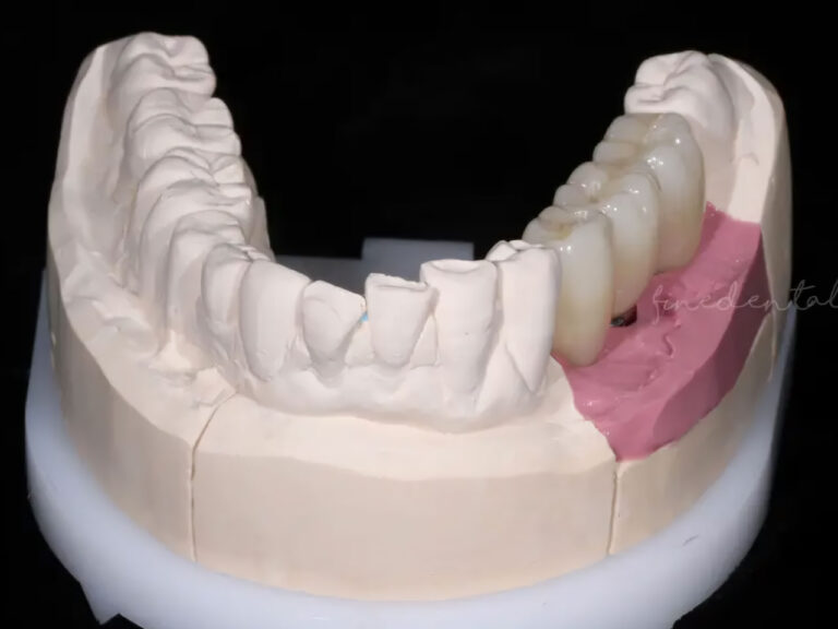 Implant_zirconia04