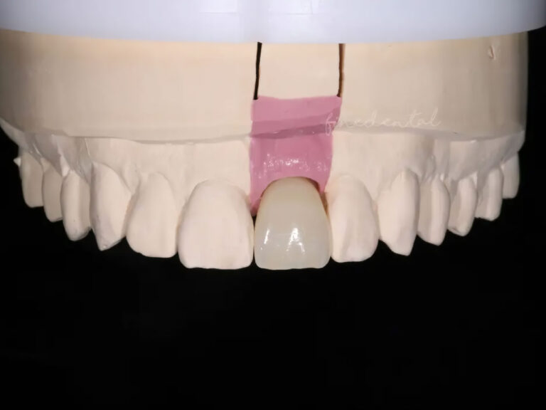Implant_zirconia05