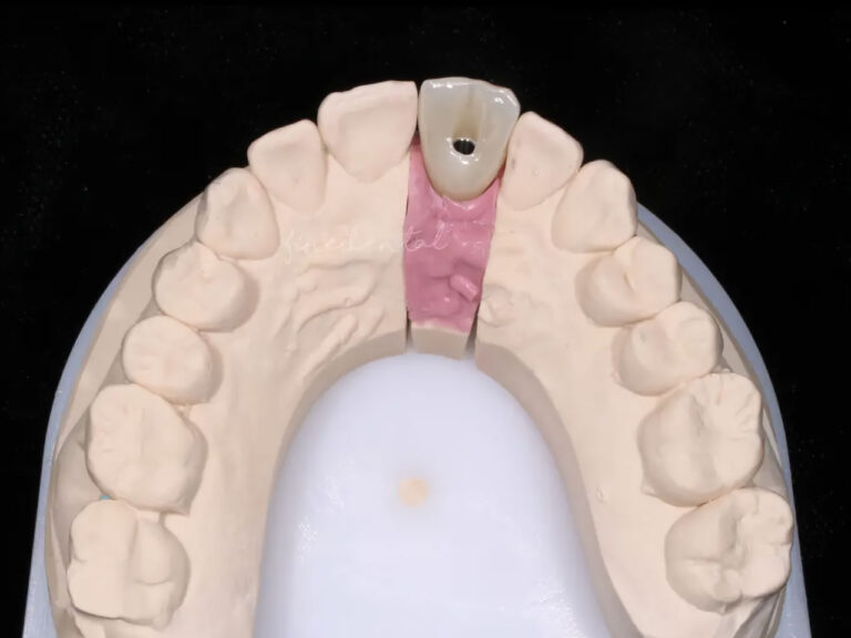Implant_zirconia06