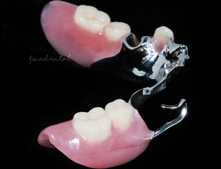 cast_plate_denture1