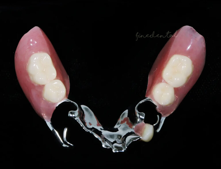 cast_plate_denture2