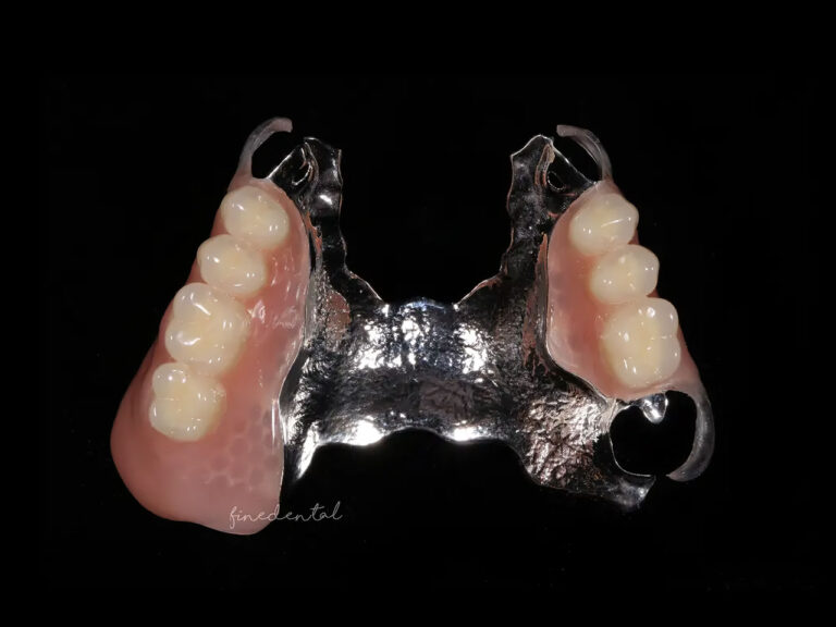 cast_plate_denture3